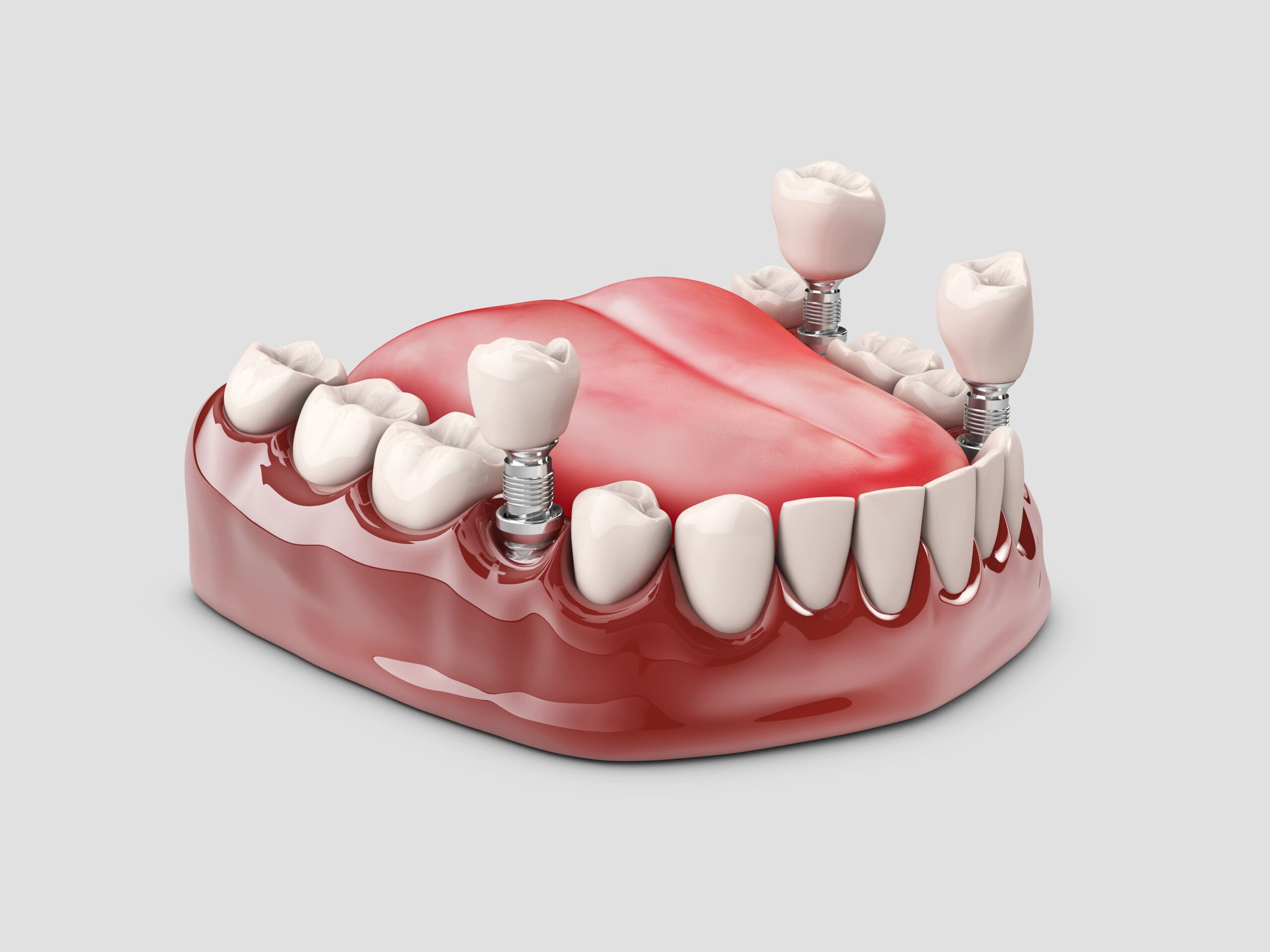 All You Need To Know About Dental Implants In Goa