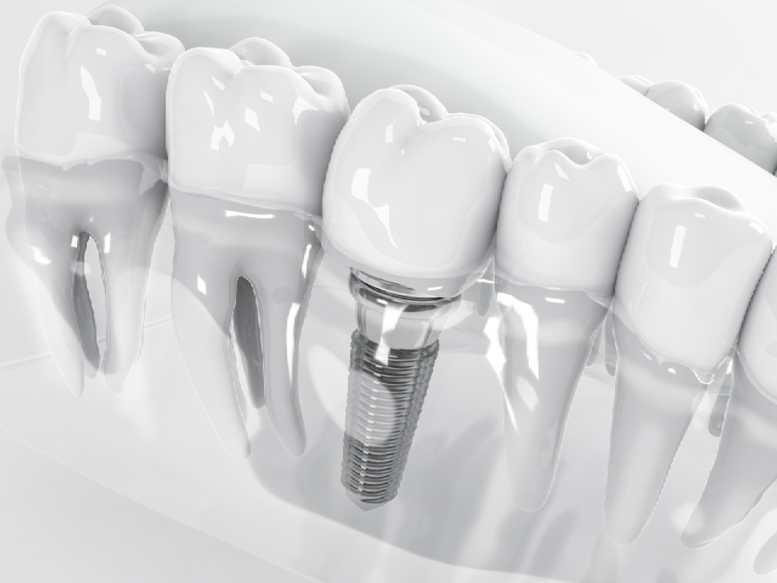 Dental Implants in Margao: Re Establish Your Smile with Confidence