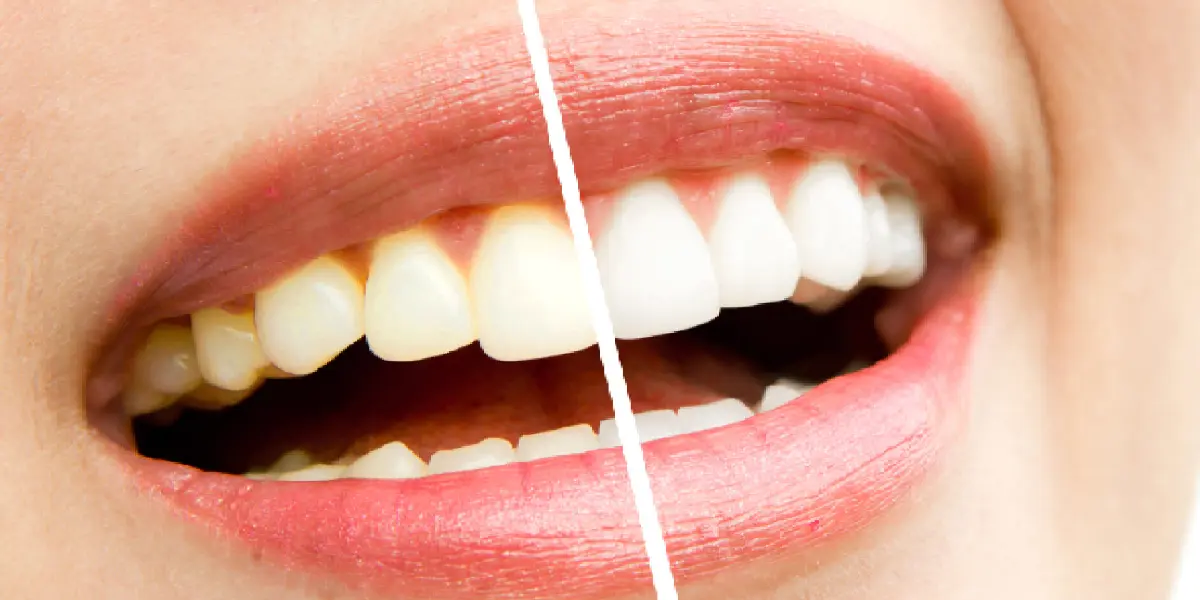 Teeth Whitening in Goa: The simplest Wedding smile makeover