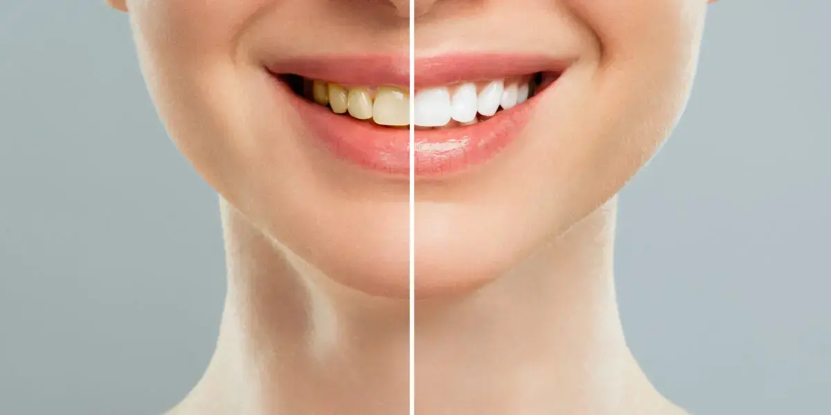 6 Reasons why Teeth Whitening is important