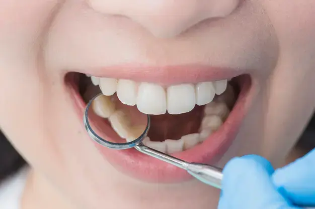 Black Gums: Causes and Solution