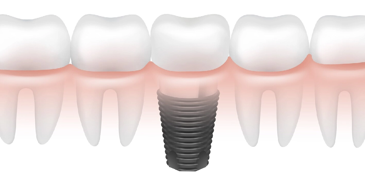 4-step guide to our dental implant process at Smile Craft
