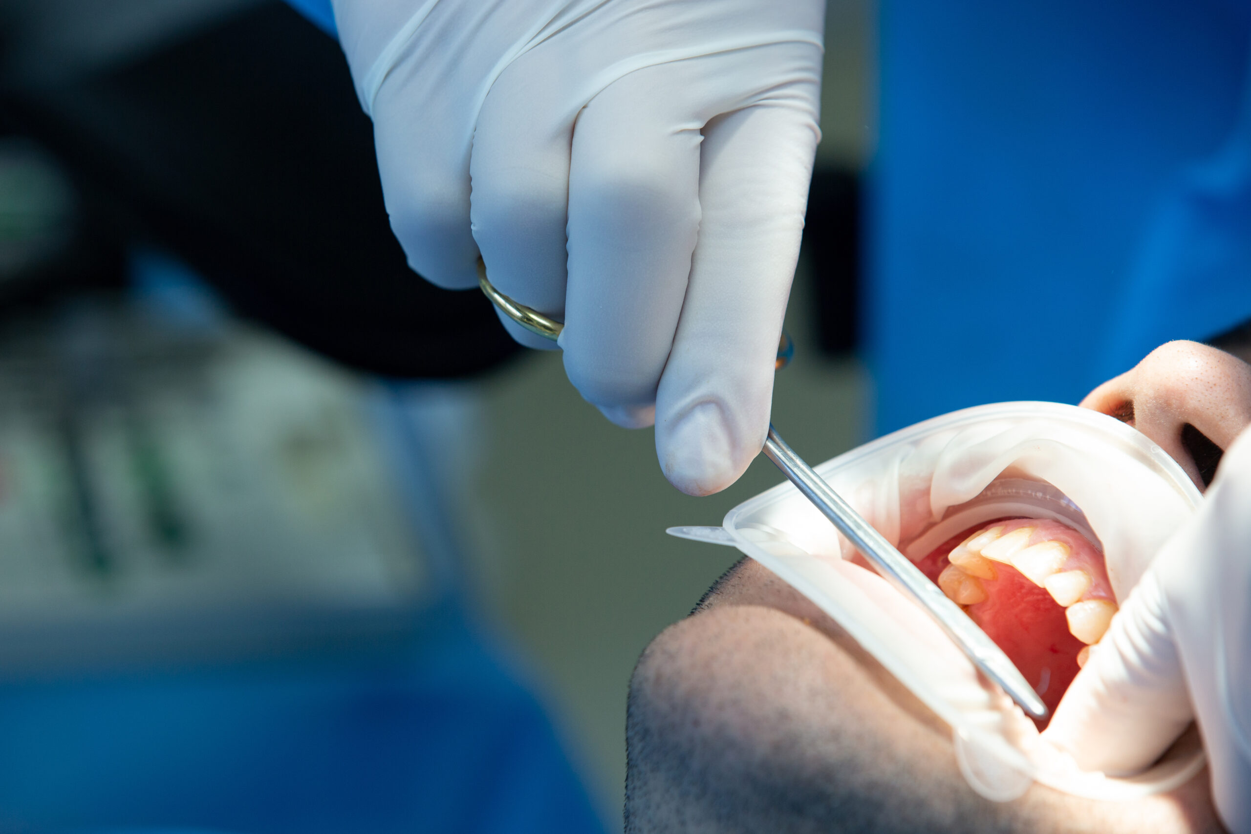 Crown Lengthening Explained: Procedure, Benefits & Recovery Tips